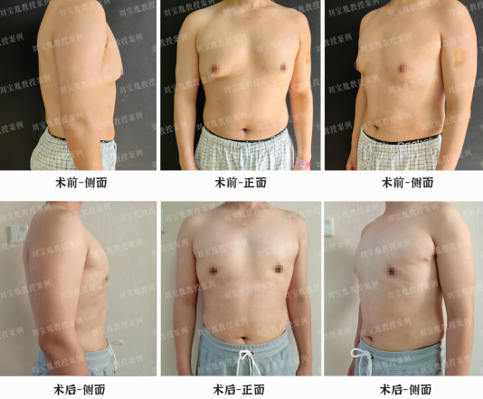 共话男性乳房发育症康复过程中的医患配合