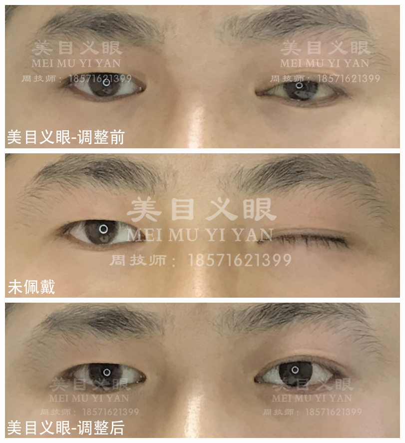 如何选择实力强的义眼定制公司，推荐这几家