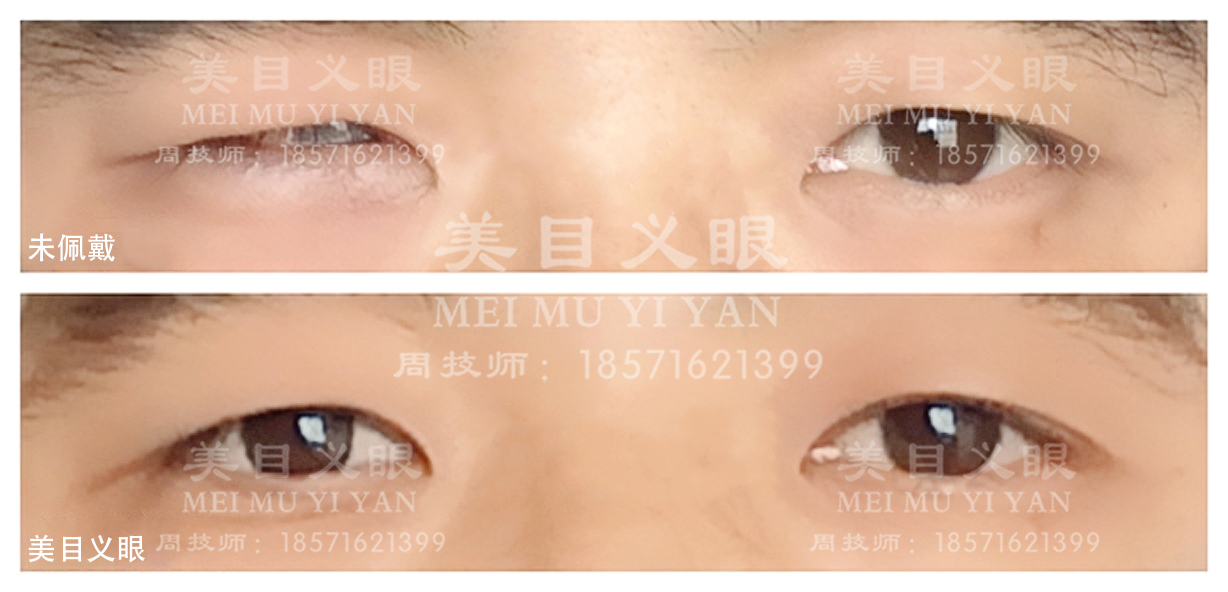 美目义眼可信度高吗？技术实力如何？值得推荐不？