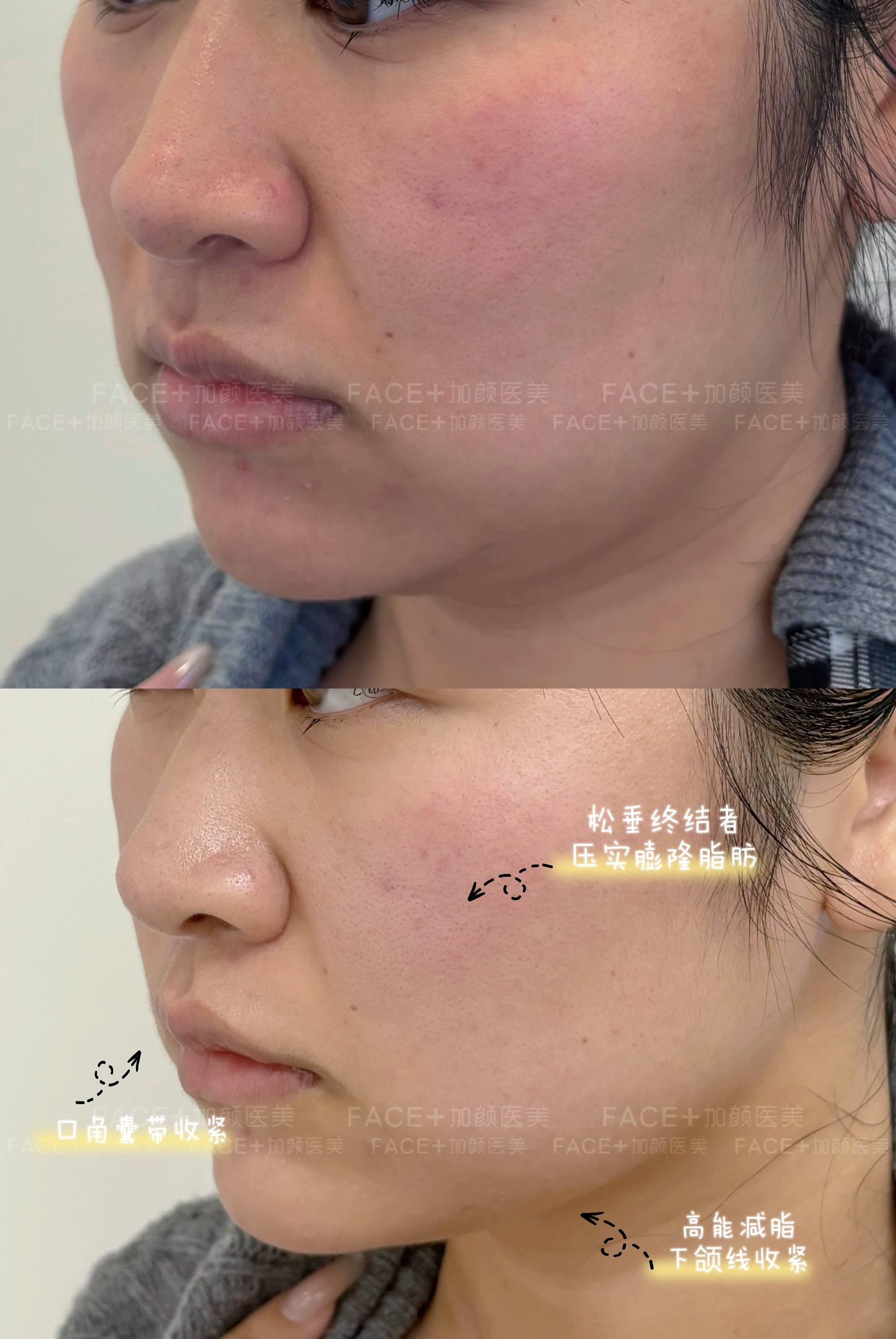 探寻半岛大超炮去双下巴，性价比高的机构怎么选择