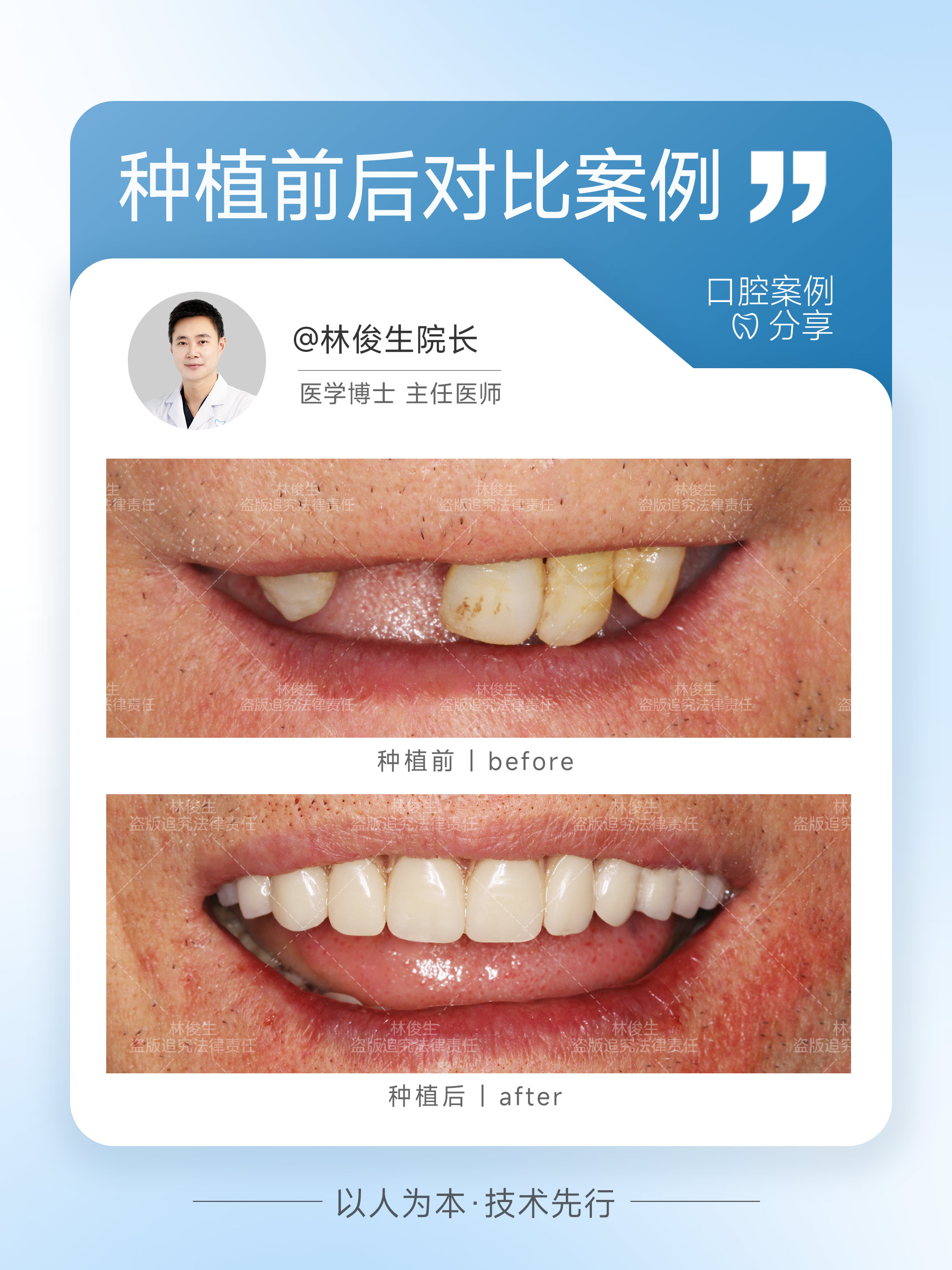 口碑不错的种植牙诊所,该如何选择? 口碑不错的种植牙诊所,该如何选择?