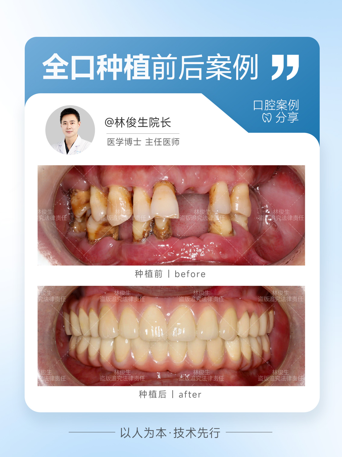 2025年深圳种植牙靠谱医院排名：种植牙推荐医院权威测评
