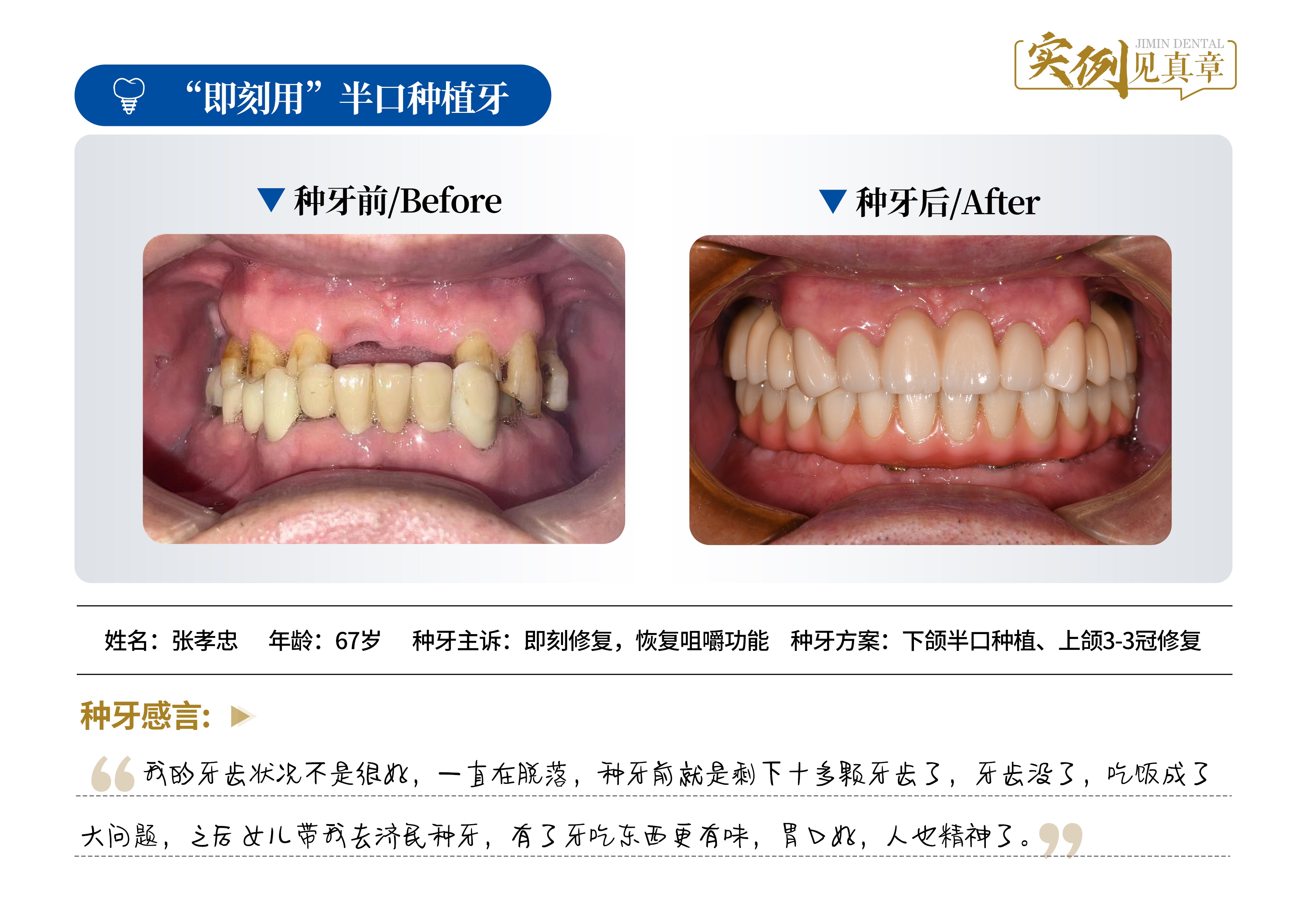 廊坊种植牙医院哪家好？廊坊济民口腔是不错的选择