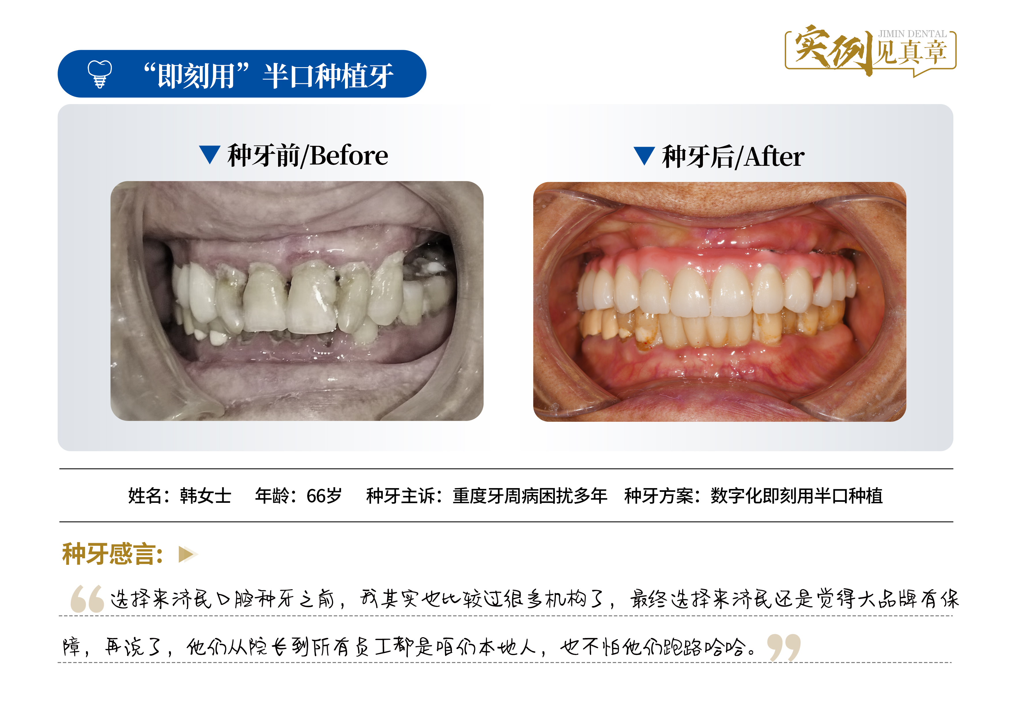 漫谈不错的种植牙诊所,说说靠谱品牌和价格情况 漫谈不错的种植牙诊所,说说靠谱品牌和价格情况