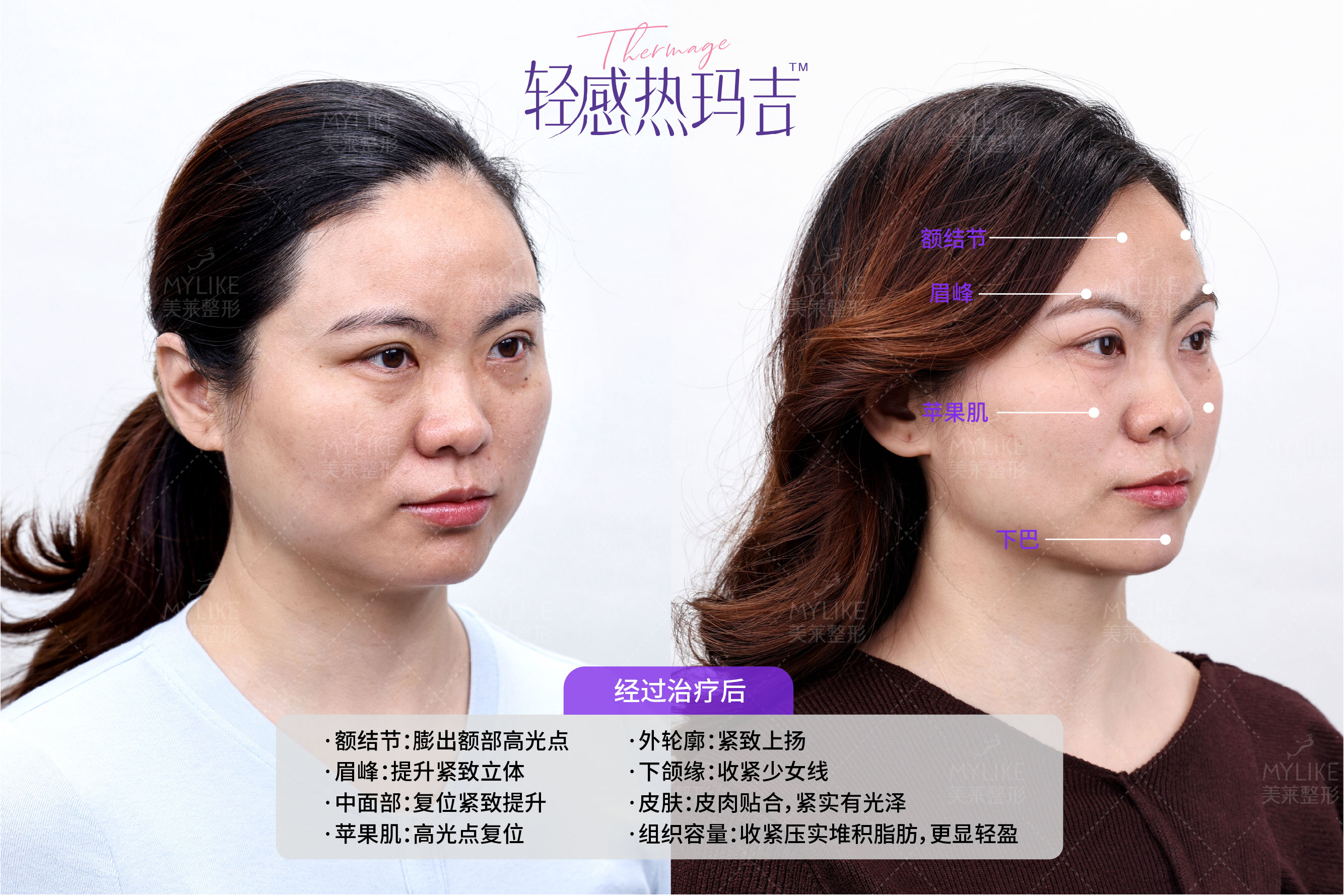 2026年度深圳热玛吉靠谱医院，聊聊热玛吉好可靠品牌