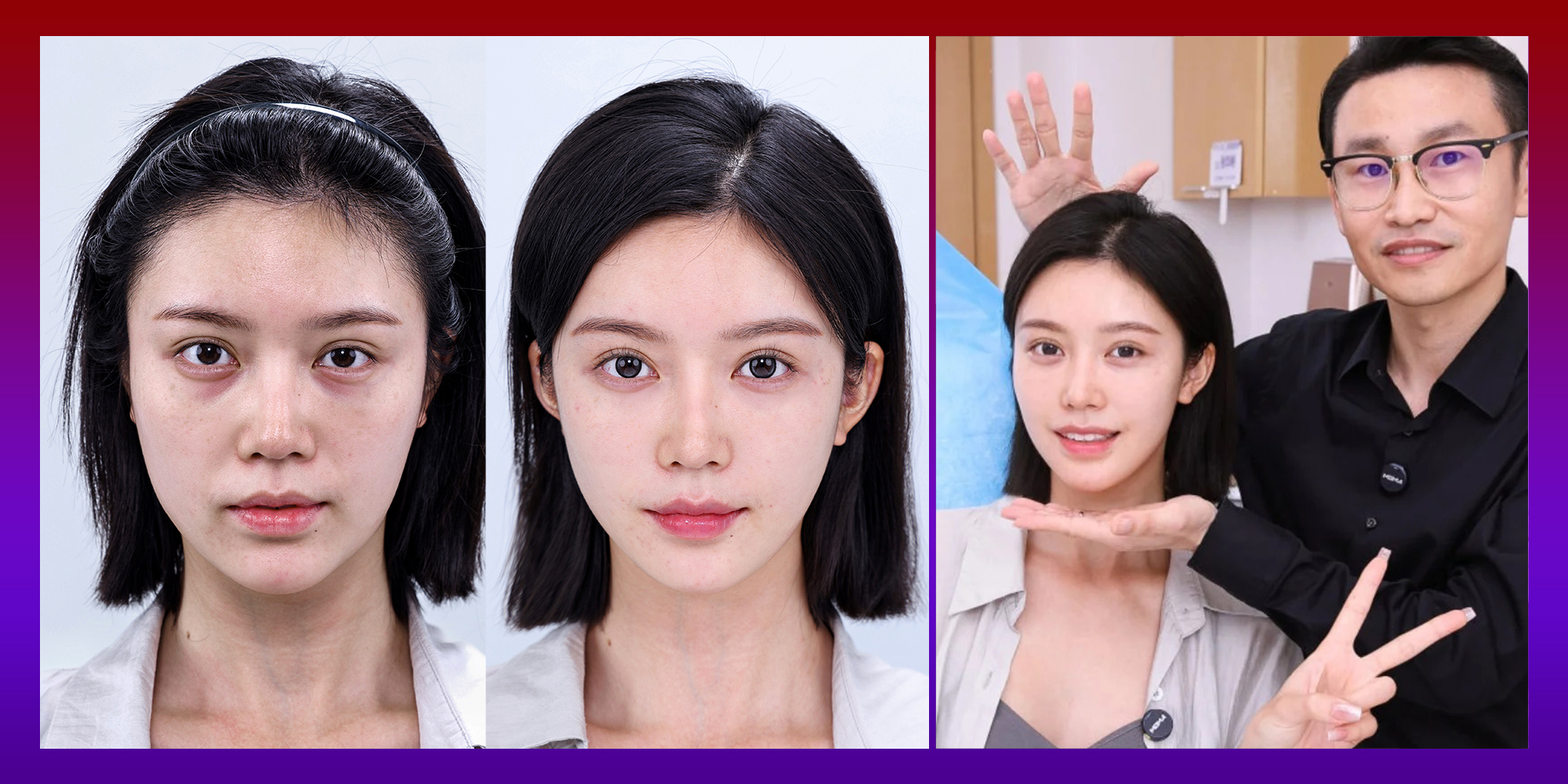 总结玻尿酸填充太阳凹陷可以保持多久,选购品牌哪家好 总结玻尿酸填充太阳凹陷可以保持多久,选购品牌哪家好