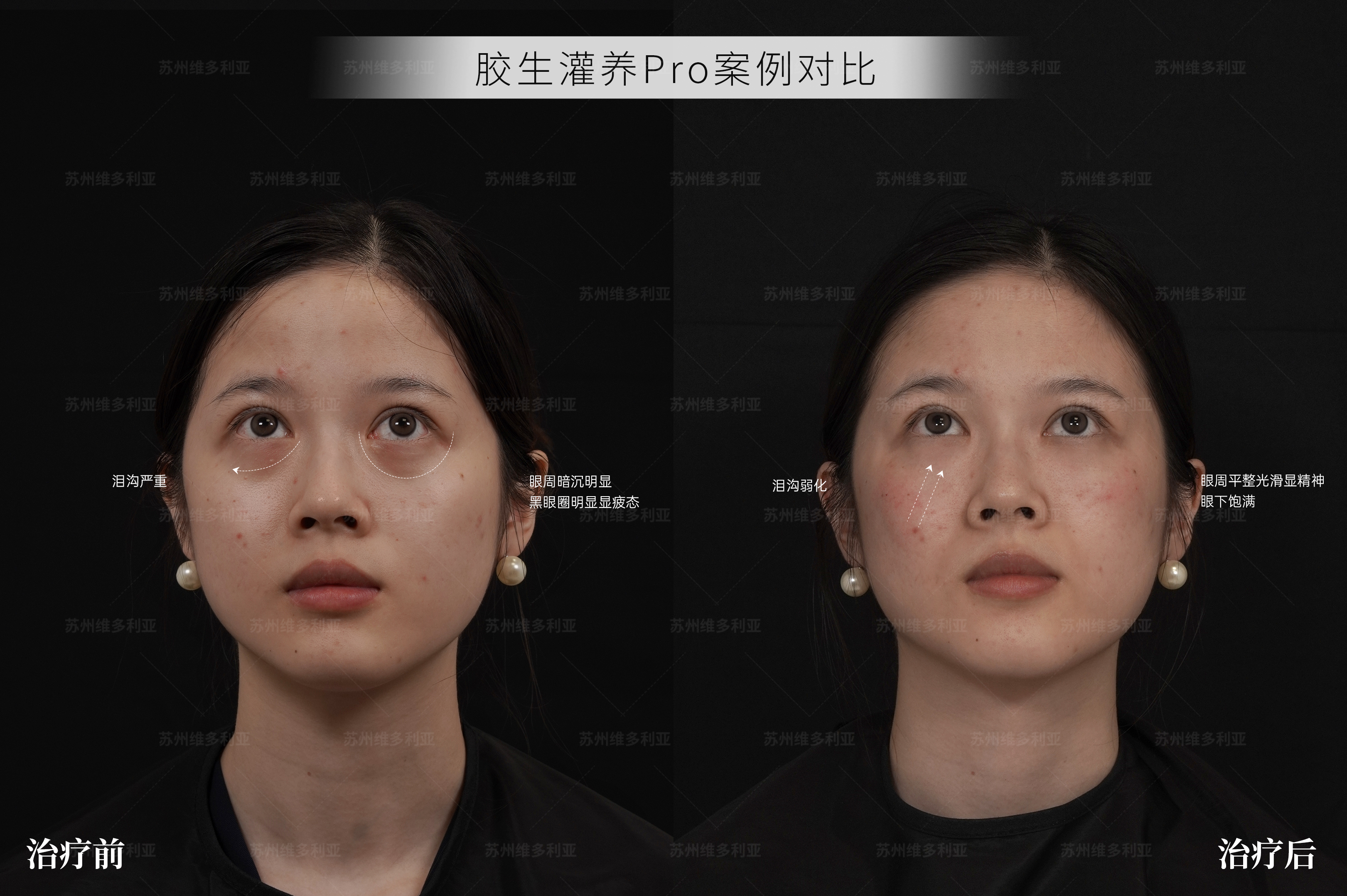 2026年眼部整形手术干货指南：苏州维多利亚靠谱吗?