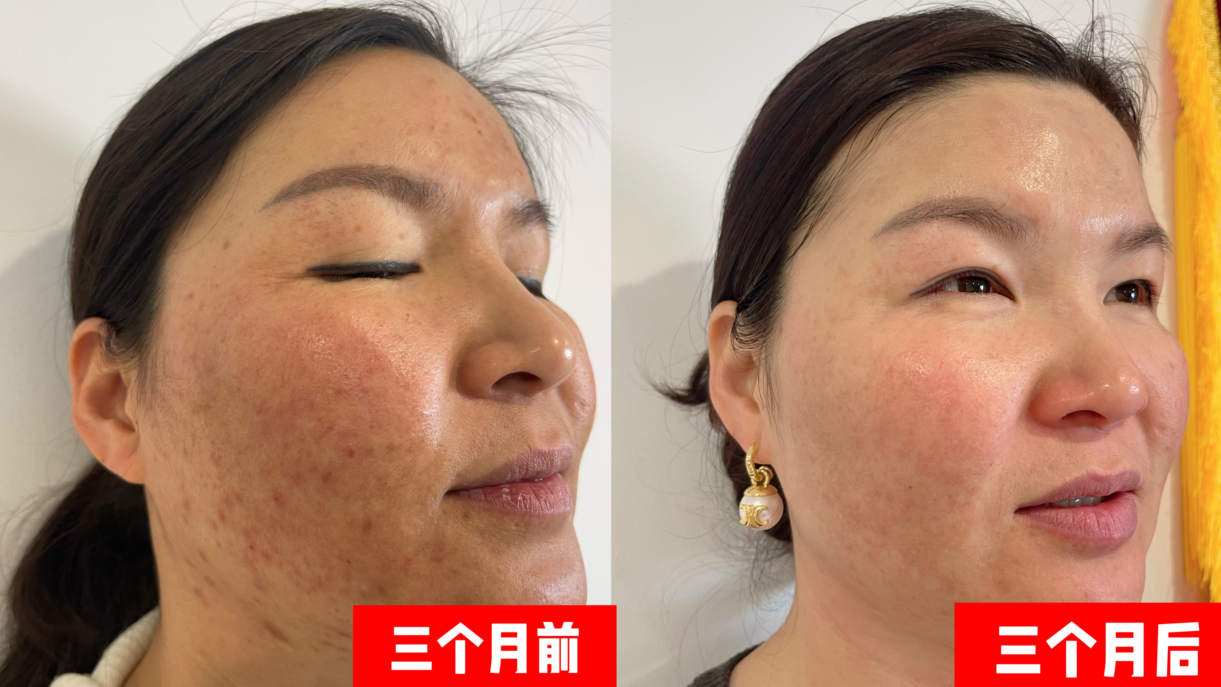 多少钱能治好青春痘