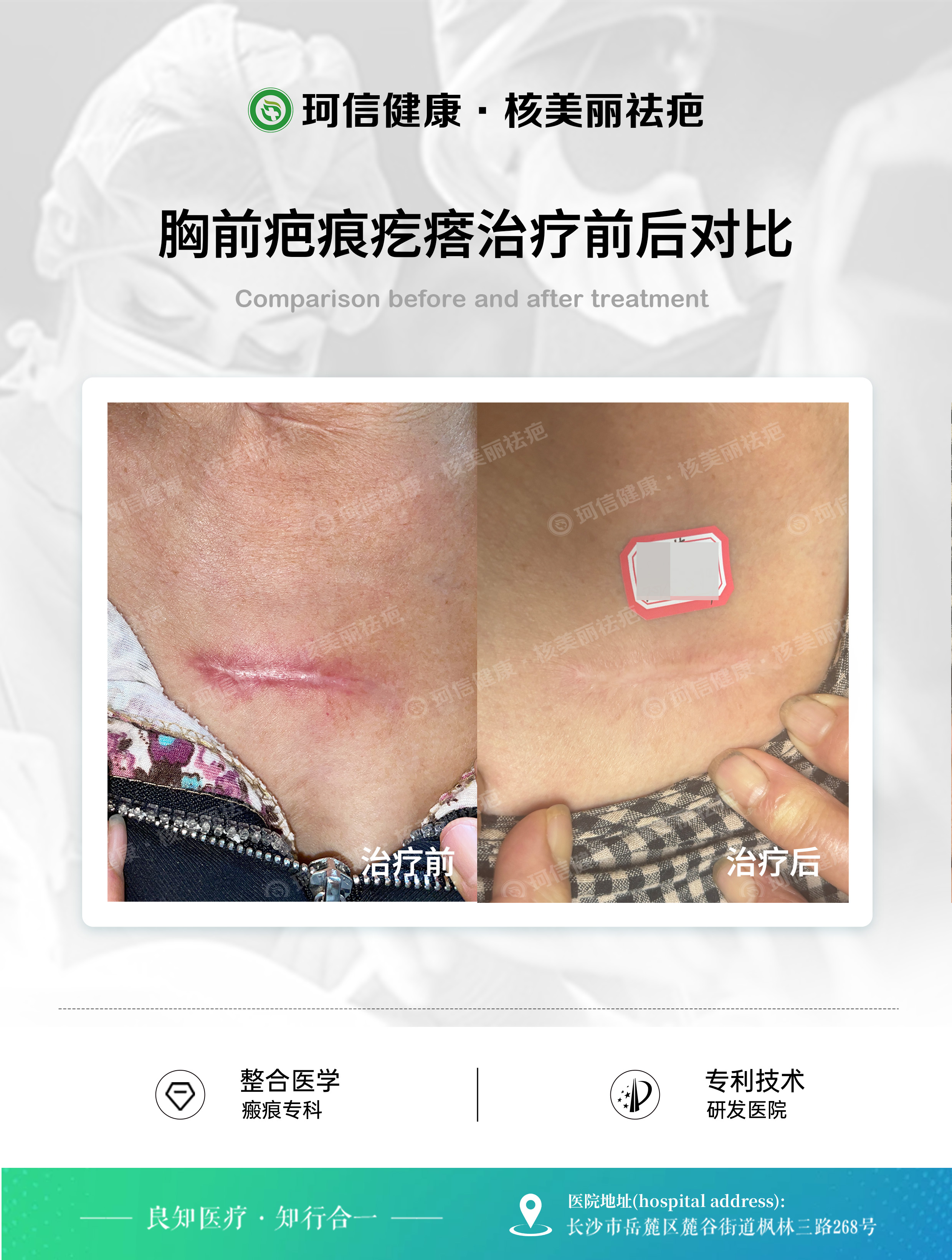 剖析长沙增生疤痕一直长推荐干预的机构，长沙核美丽有妙招
