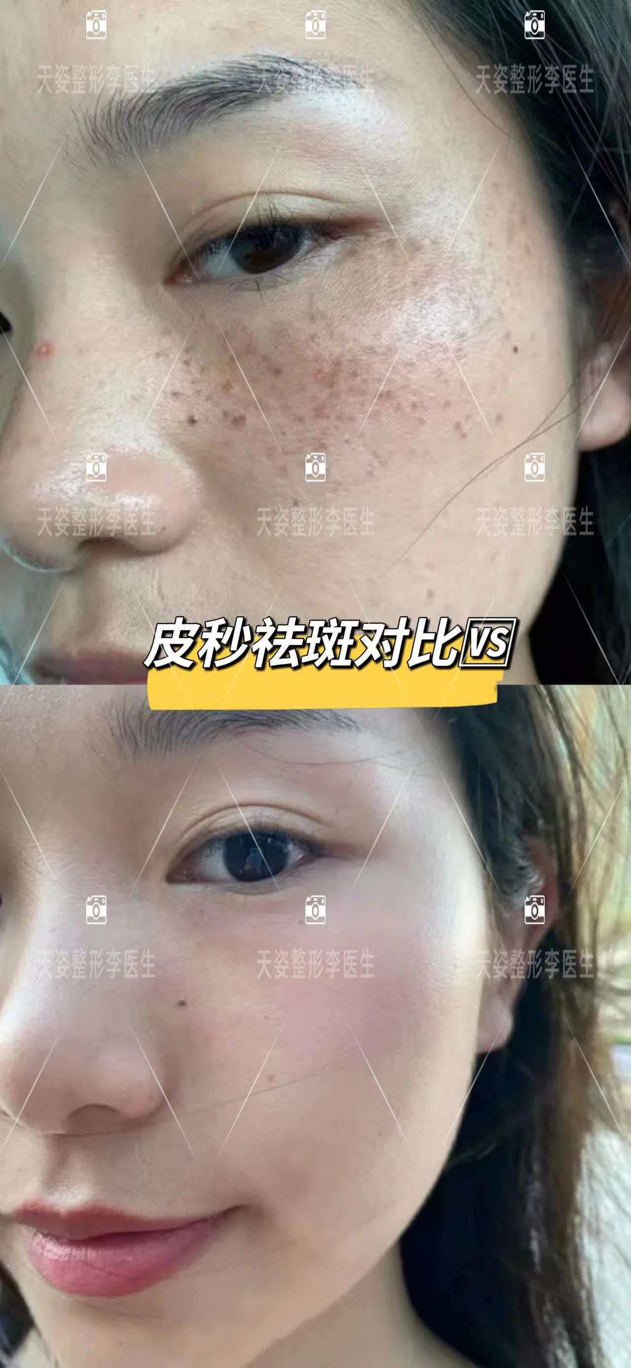 探讨怀化做脱毛医院怎么选择，哪个医院性价比高