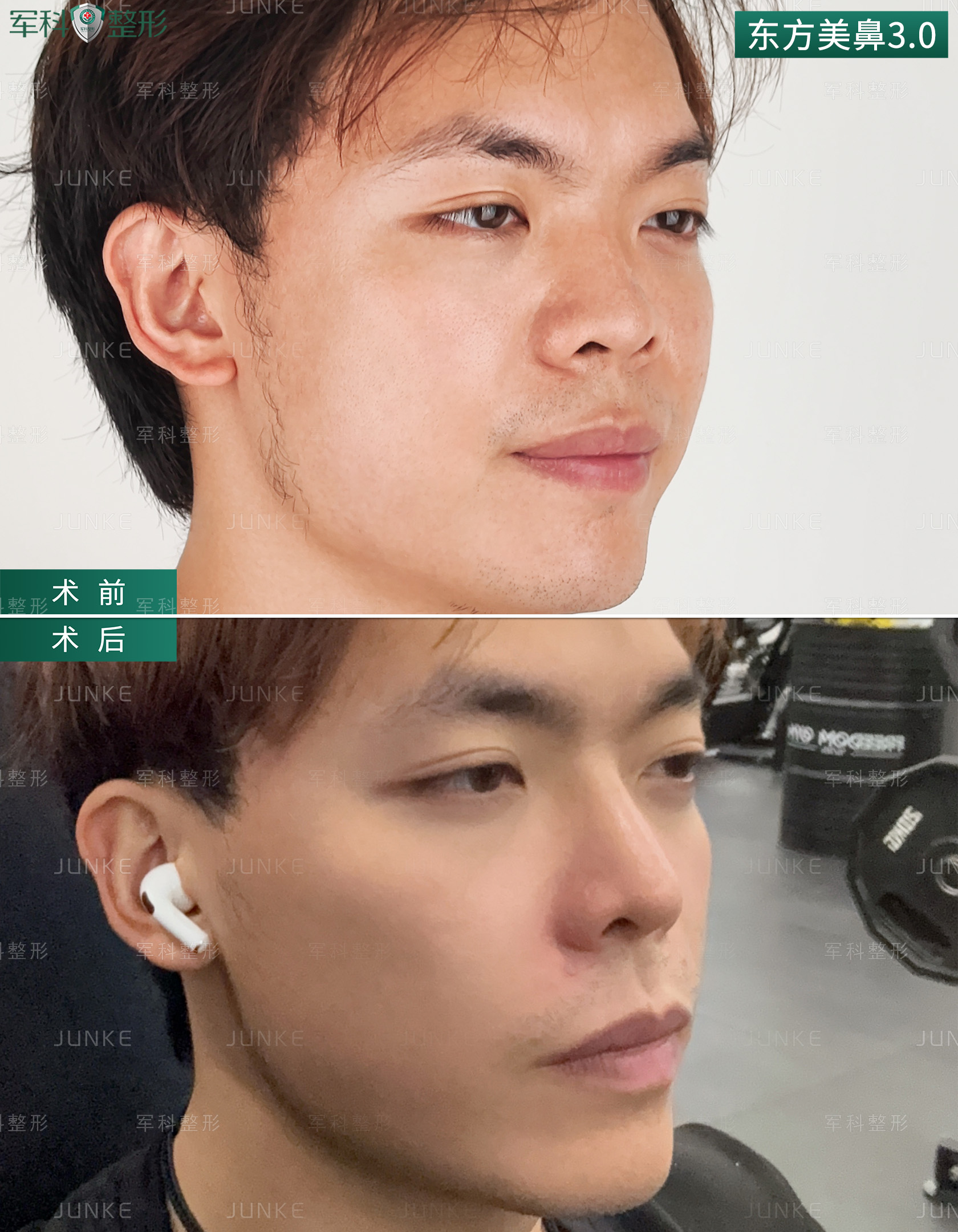 鼻整形服务哪家性价比高，和你一起品味鼻整形流程及护理