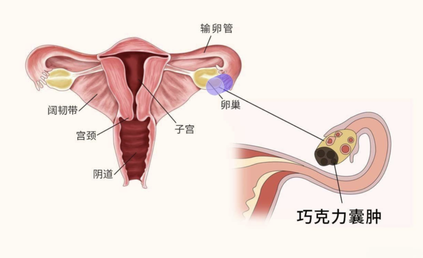 西安巧克力囊肿做微创，这些推荐医院你了解吗