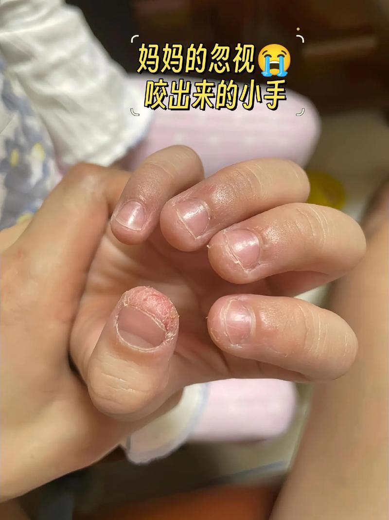 2026年靠谱的戒啃手品牌,给孩子买不踩坑的戒吃手指甲产品推荐 2026年靠谱的戒啃手品牌,给孩子买不踩坑的戒吃手指甲产品推荐
