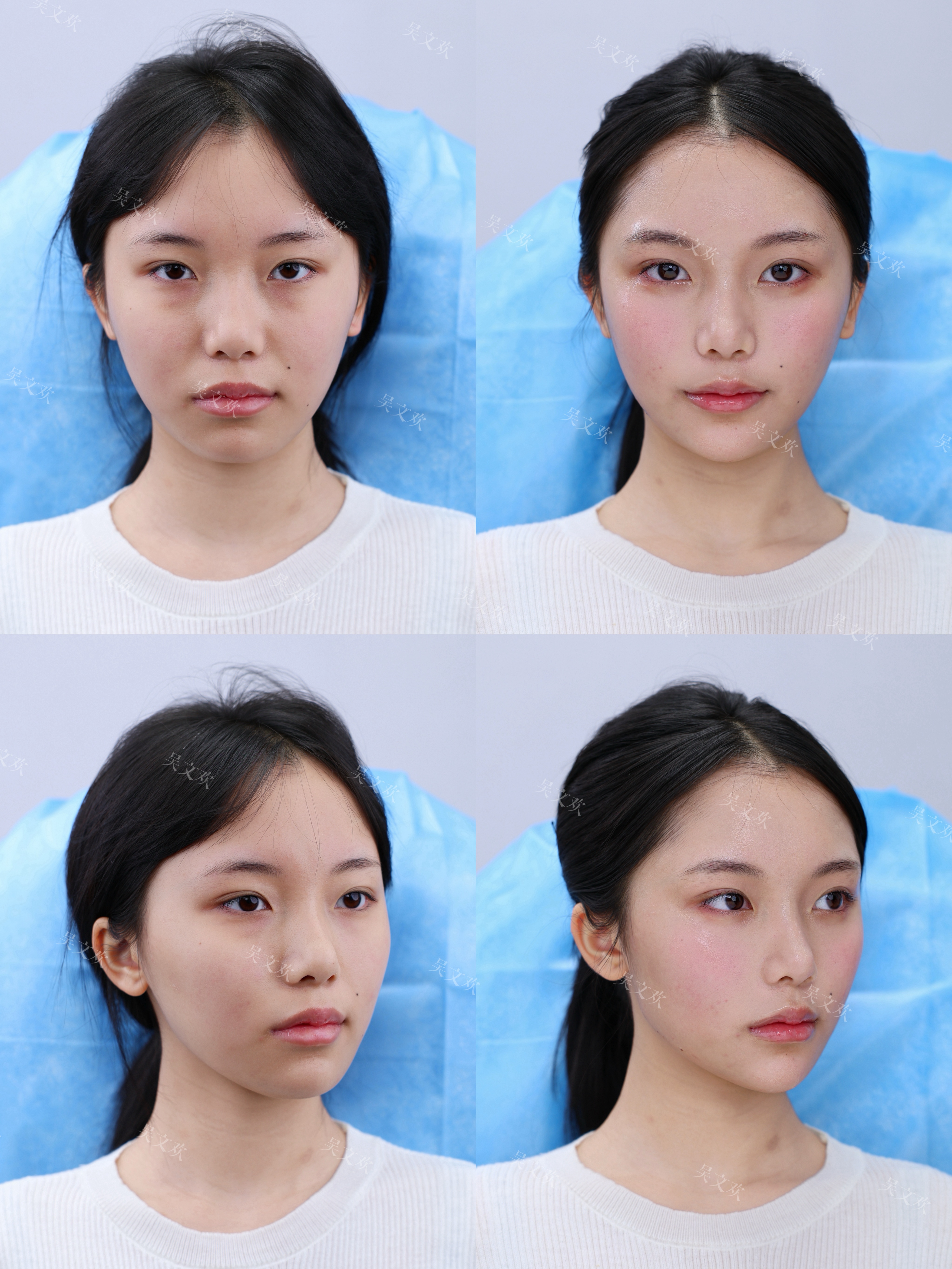 2026年南京面部提升哪家好?美莱医美值得推荐!