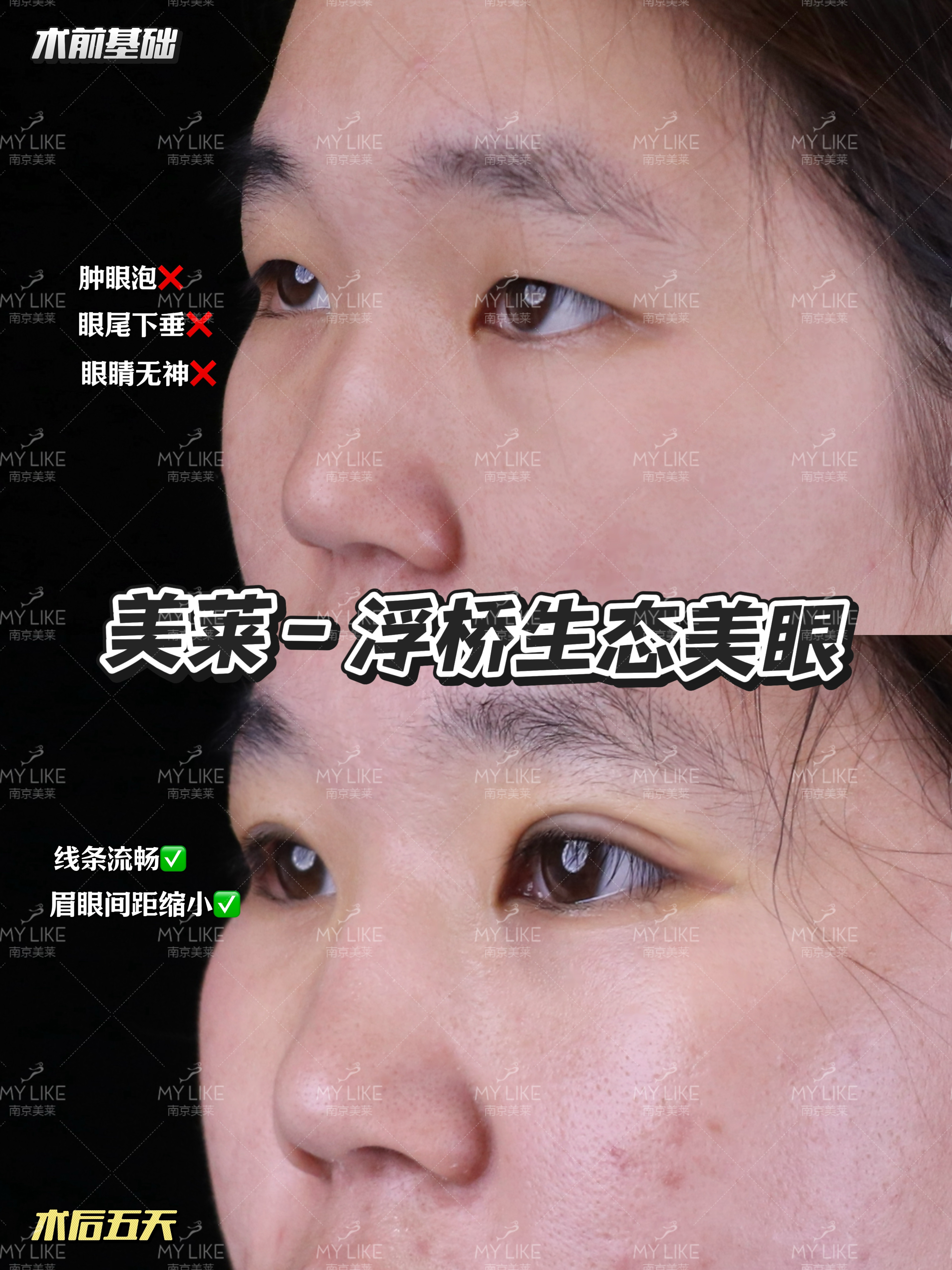想做闭眼无痕的割双眼皮推荐南京哪家机构