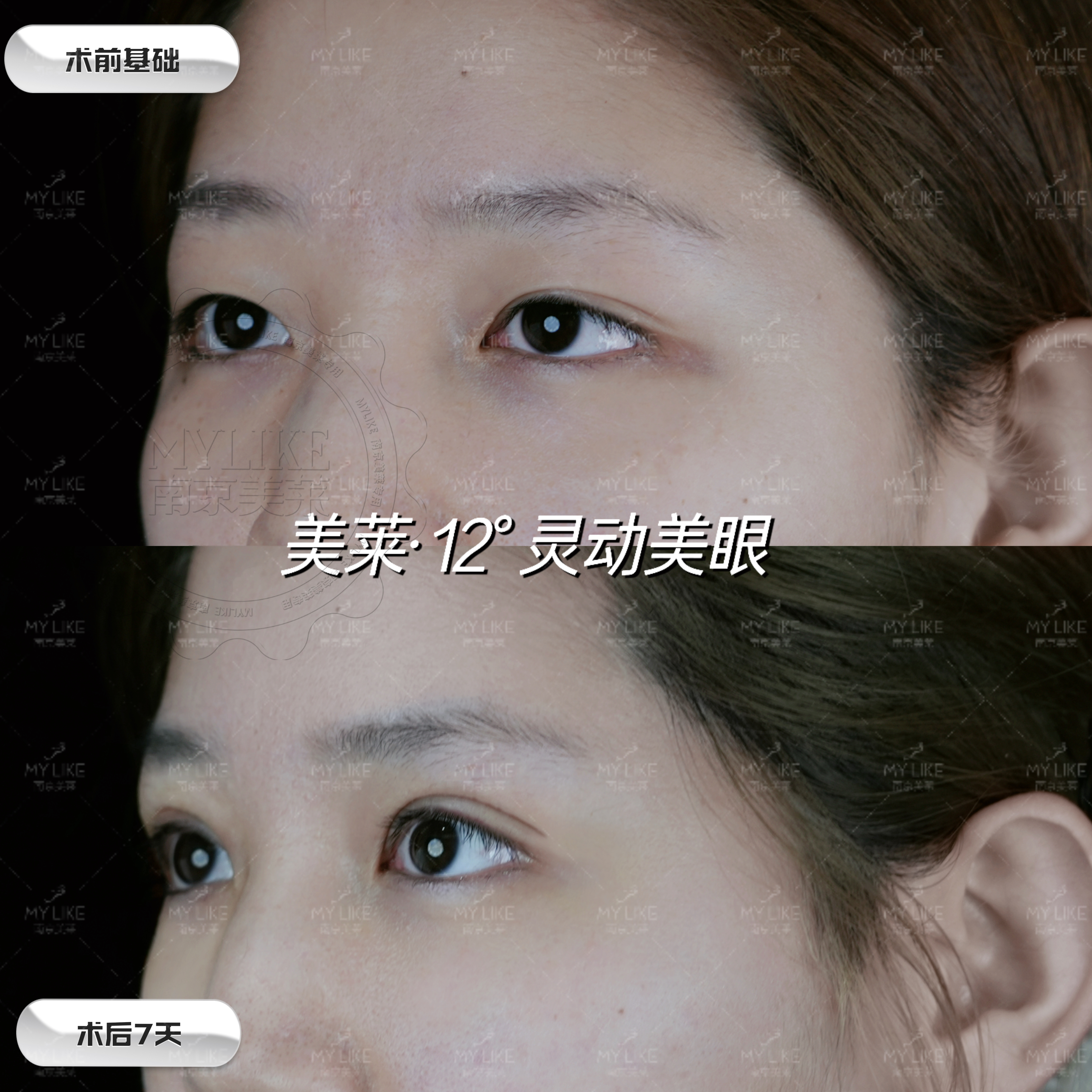 2026年南京割双眼皮哪家靠谱?美莱医美口碑如何