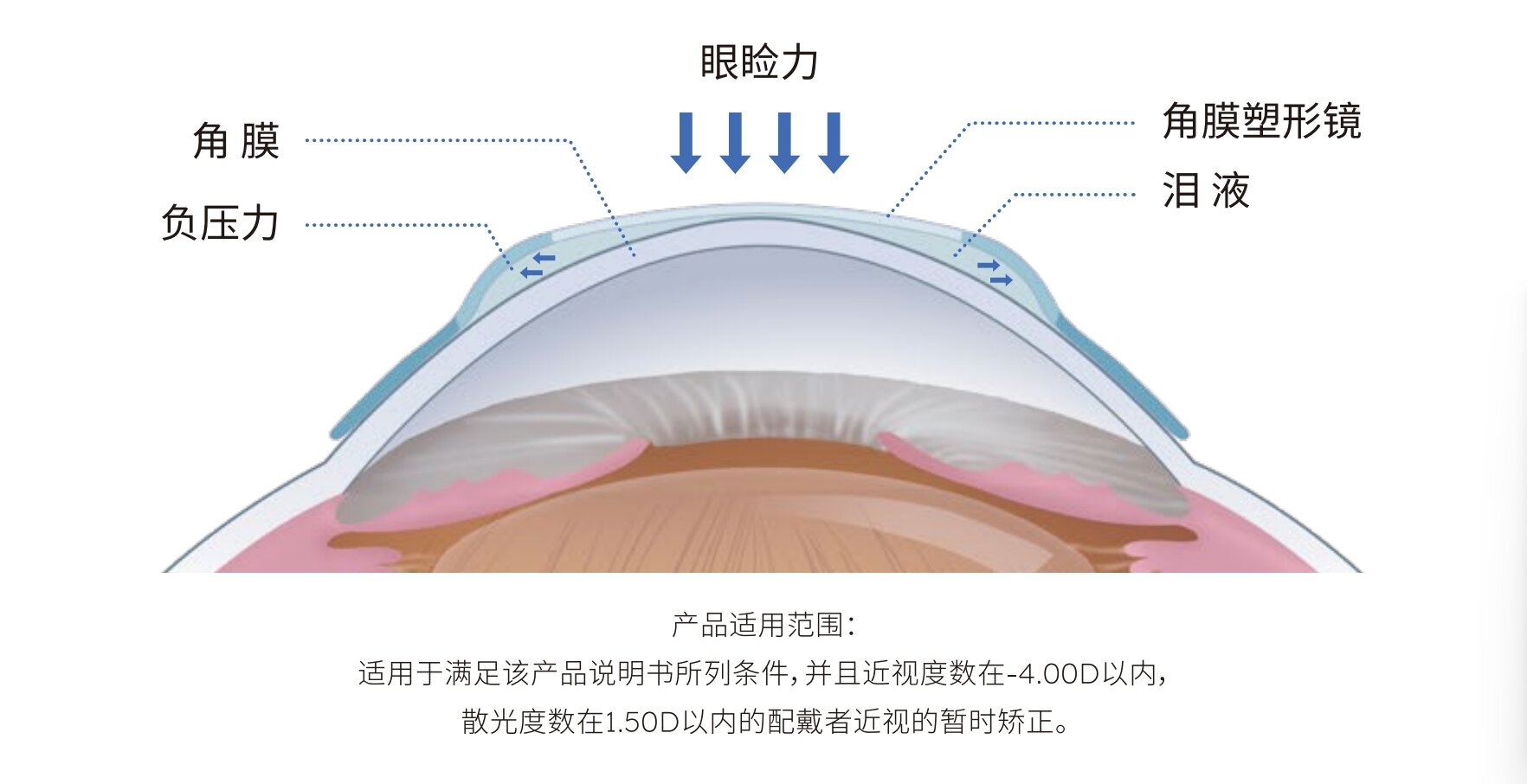 OK镜光学设计趋势：小光学区非球面成新一代标准
