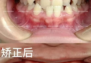 隐形矫正口腔医院哪家矫正不伤牙根？专业机构选择指南与用户口碑