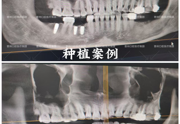 正规连锁种植牙口腔医院 专业实力与用户口碑深度解析