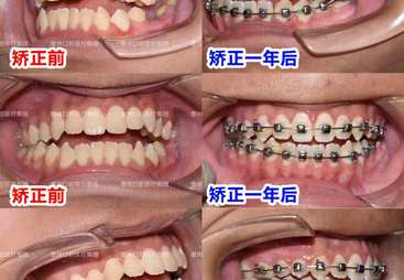 隐形矫正口腔医院哪家医生口碑好，行业现状与选择指南