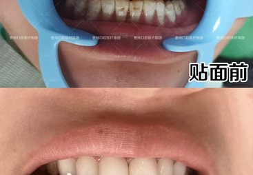 2026年菏泽分层树脂贴面推荐哪家口腔医院，用户力荐实力参考