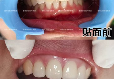 菏泽东明县2026年哪里能一站式做牙齿贴面改善牙黄，靠谱医院推荐