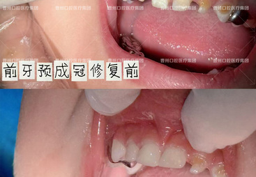 牡丹区知名的儿童牙科口腔医院处理孩子蛀痛实力推荐