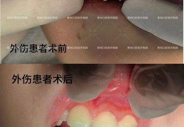 2026年菏泽靠谱的二级口腔医院做贴面推荐，无异物感贴面优选
