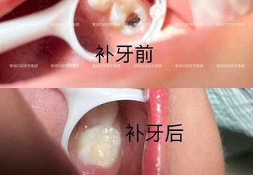 菏泽孩子偏颌早期干预与数字化口腔检查机构综合实力推荐